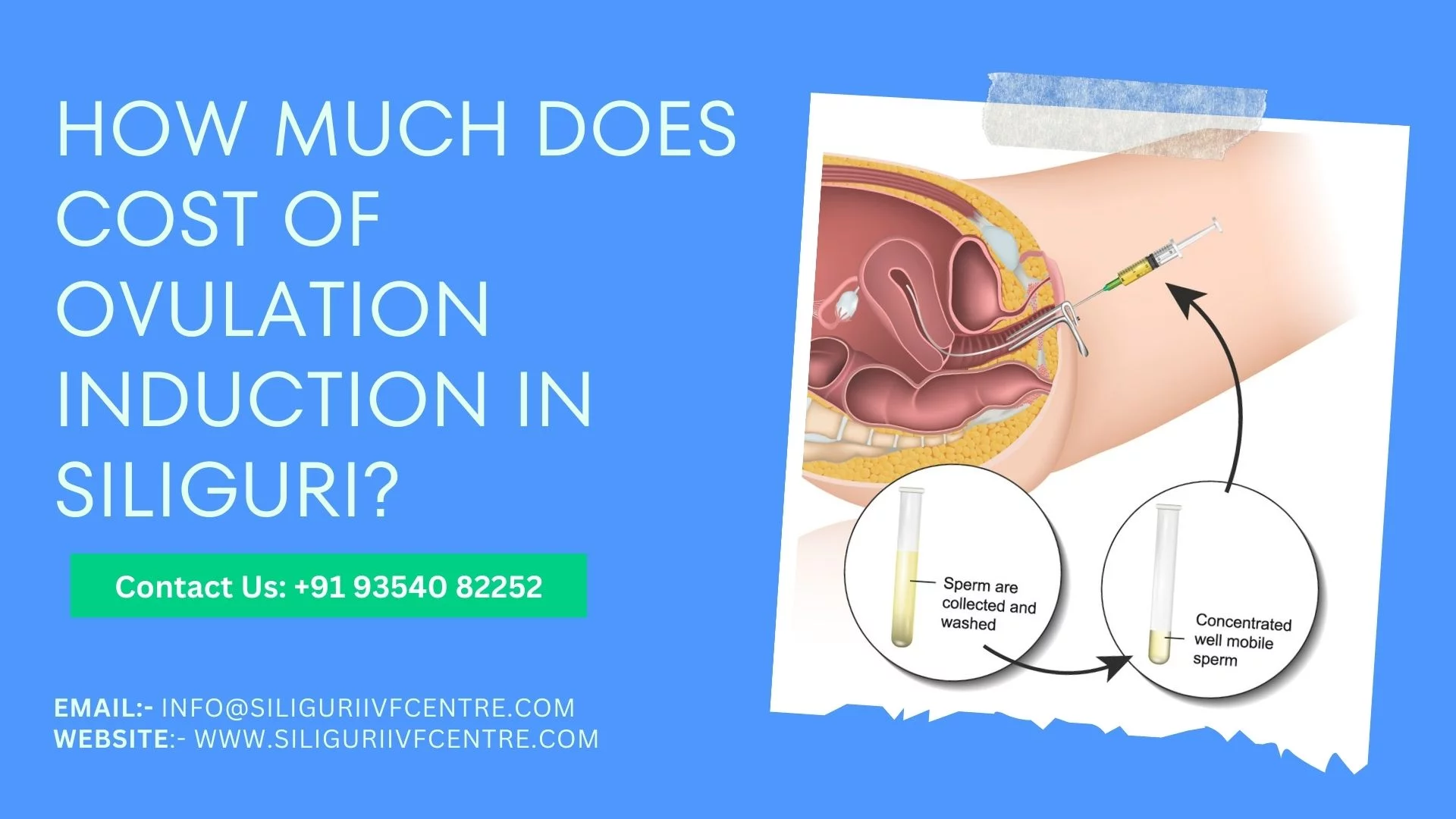 Cost of Ovulation Induction in Siliguri