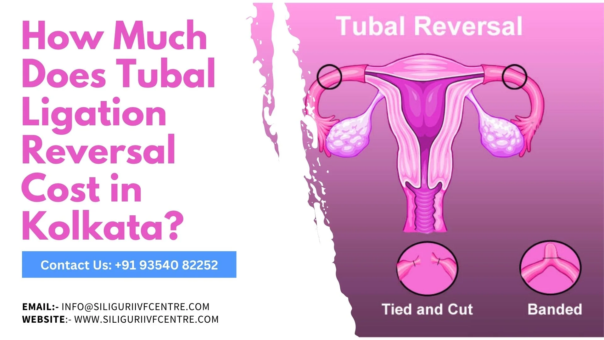 Tubal Ligation Reversal Cost in Kolkata